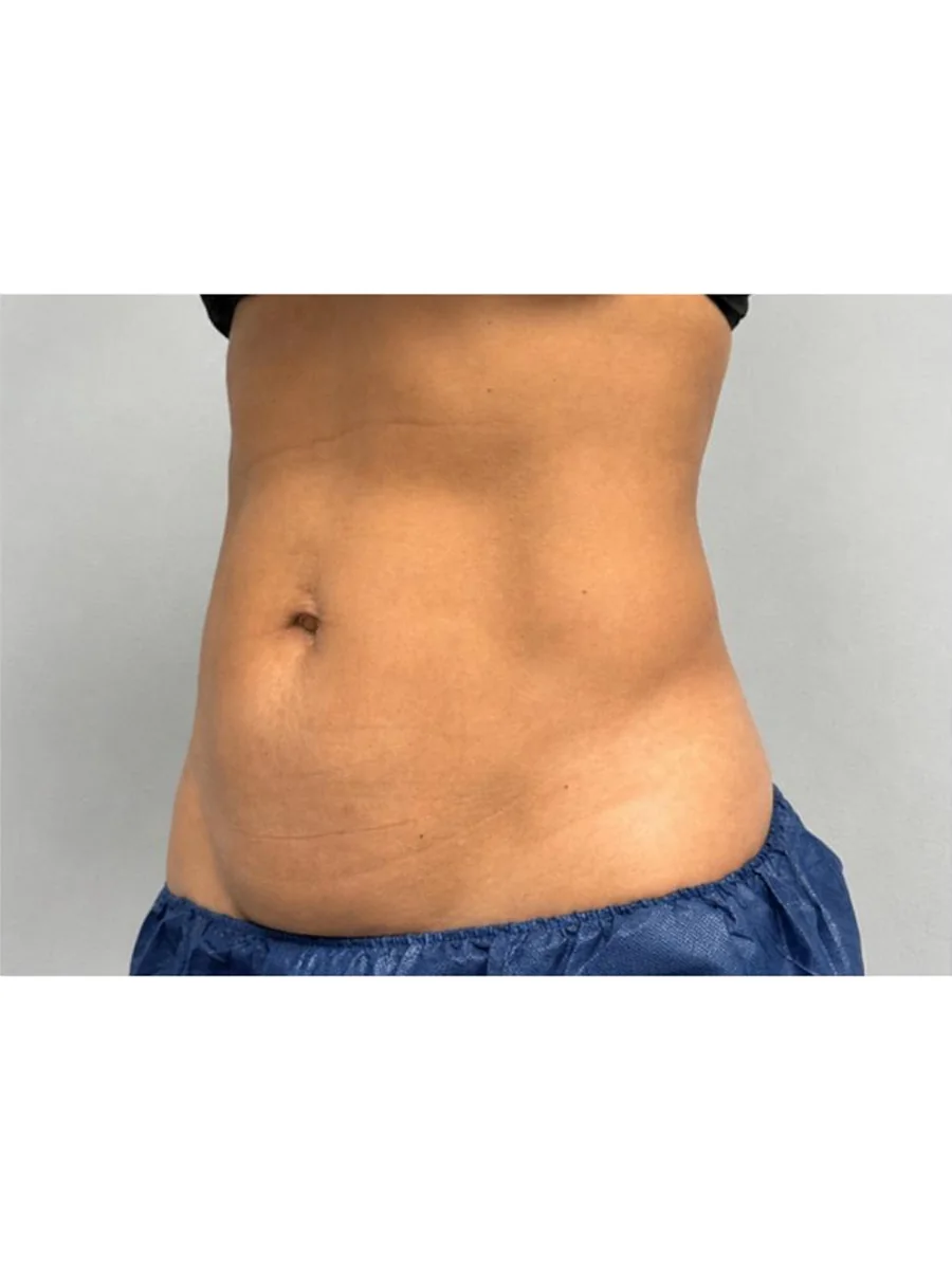 Body Contouring after