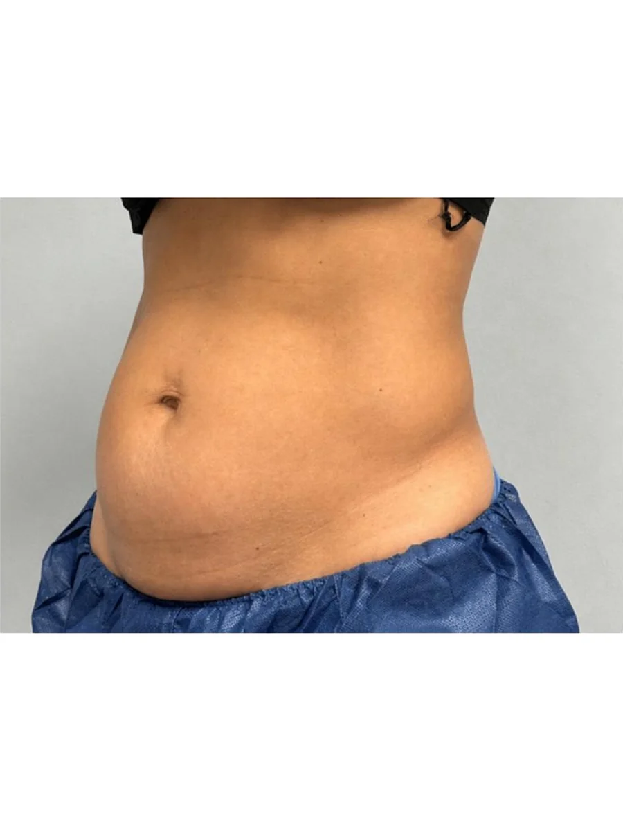 Body Contouring before