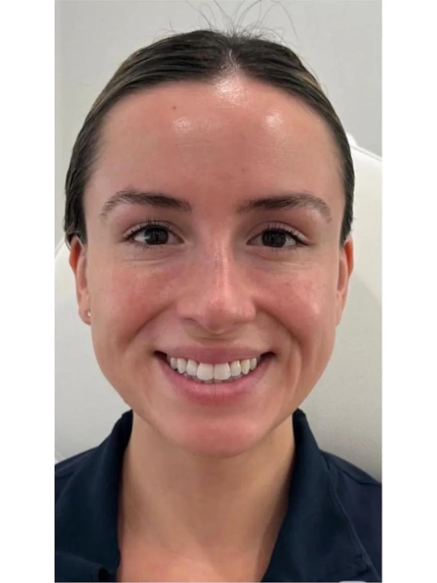 Facial Rejuvenation after