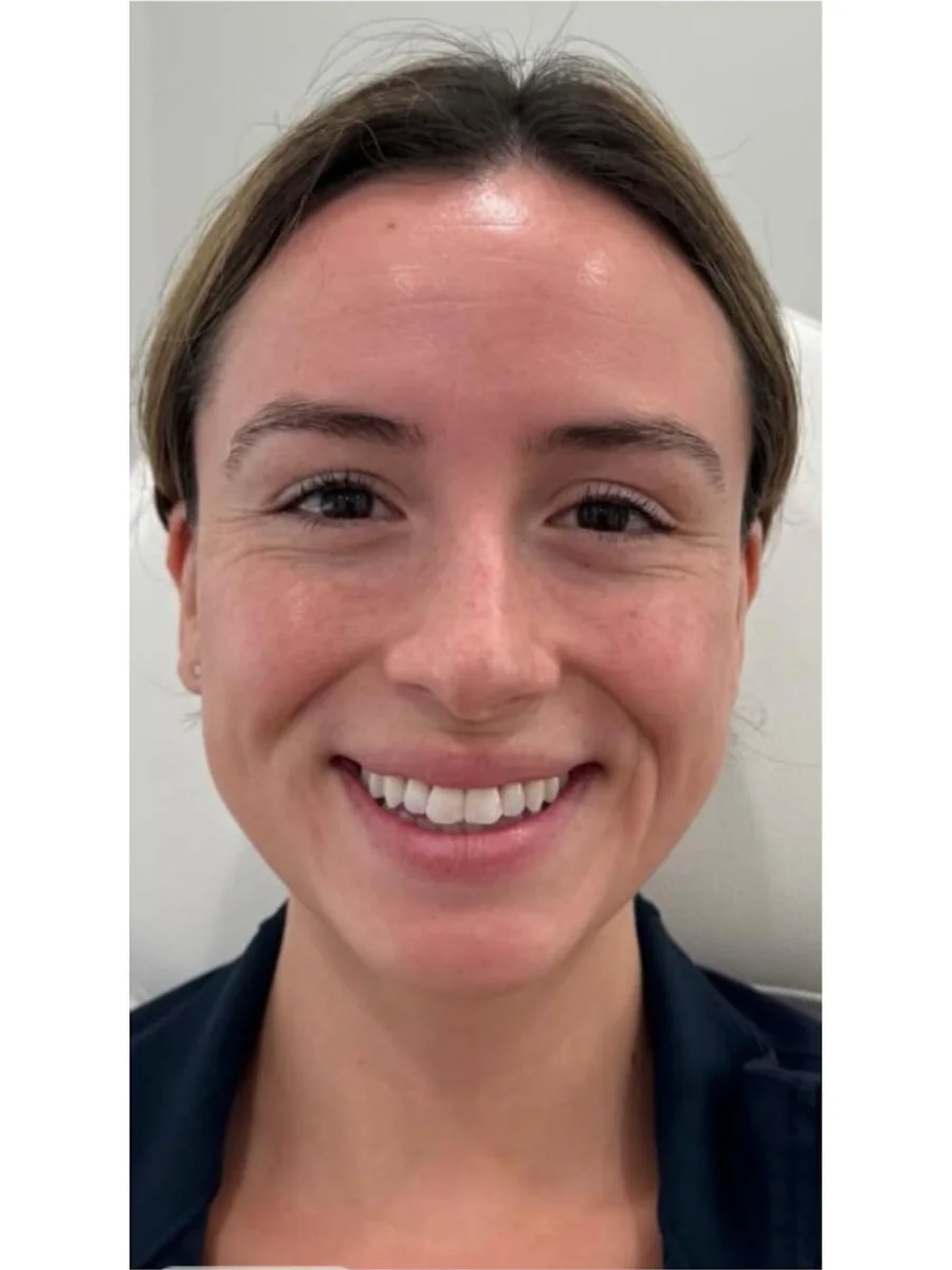 Facial Rejuvenation before