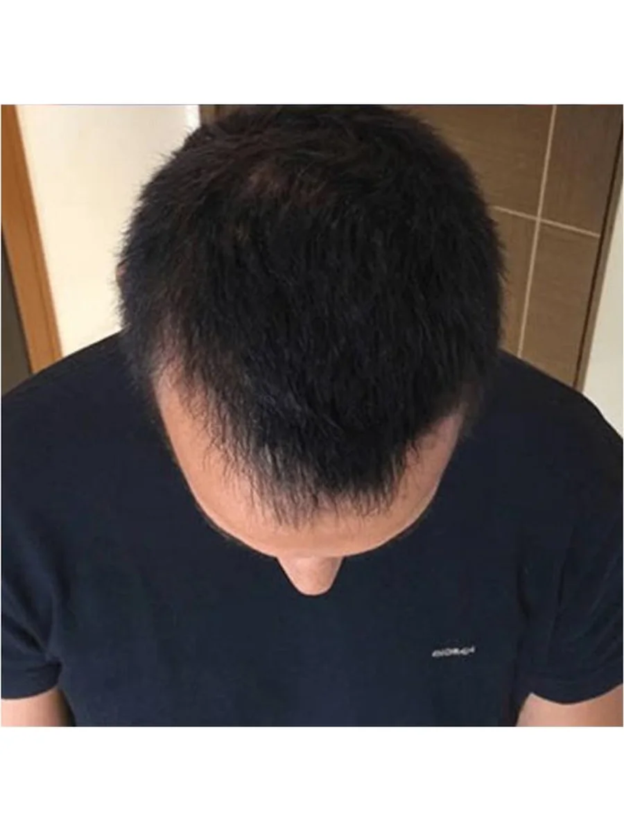 Hair Restoration after