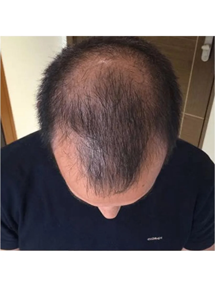 Hair Restoration before