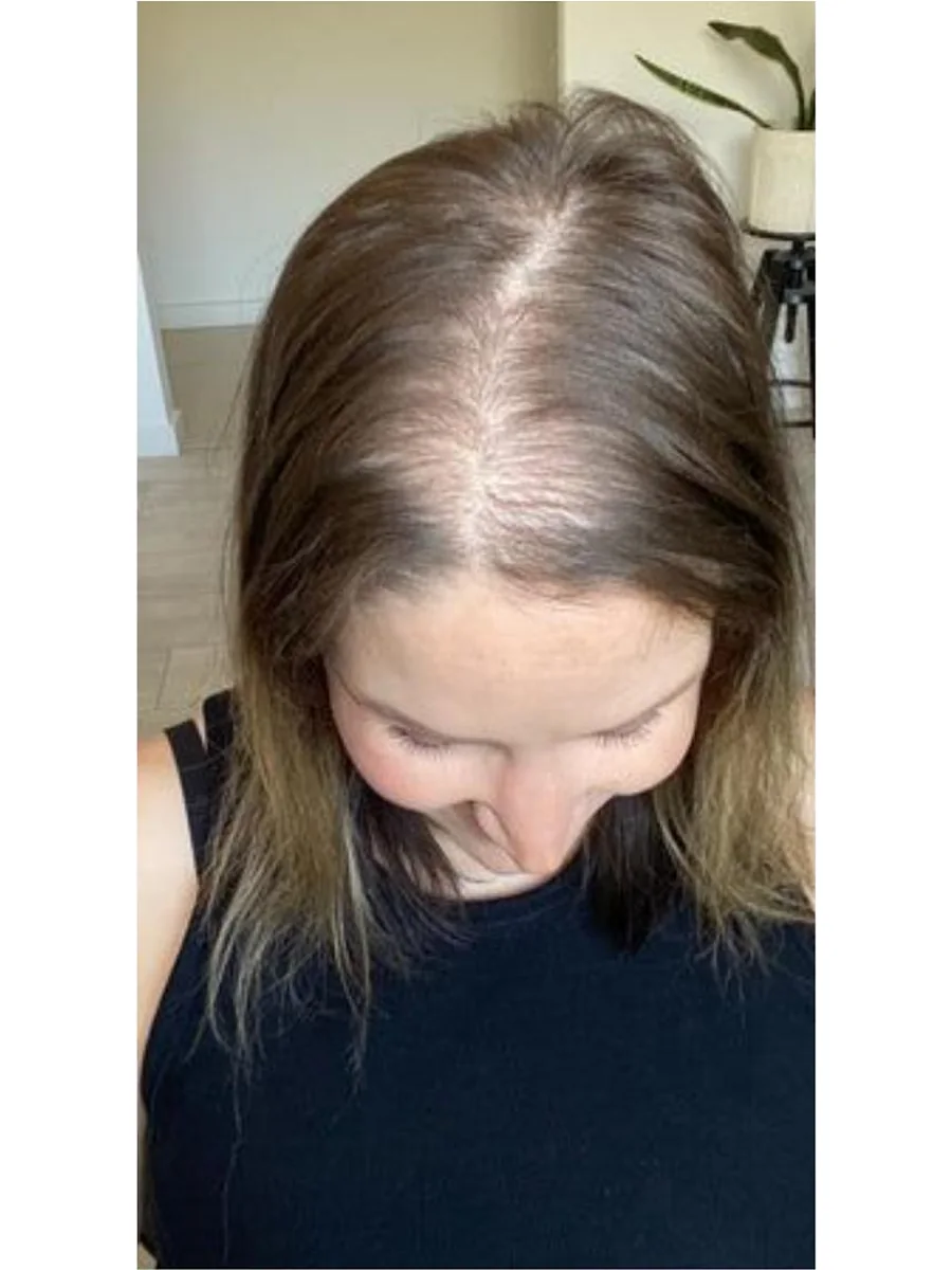 Hair Restoration before