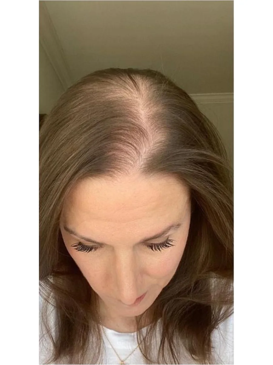 Hair Restoration before