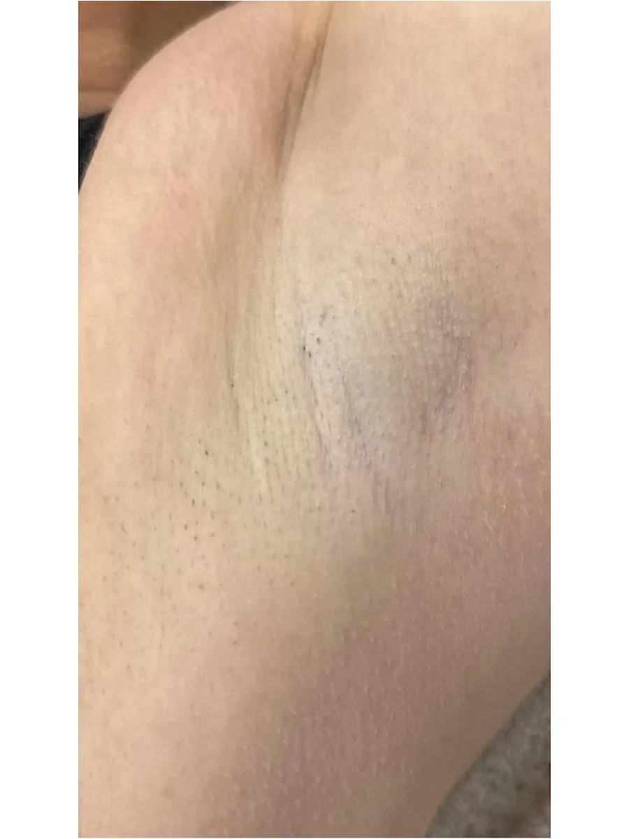 Laser Hair Removal after