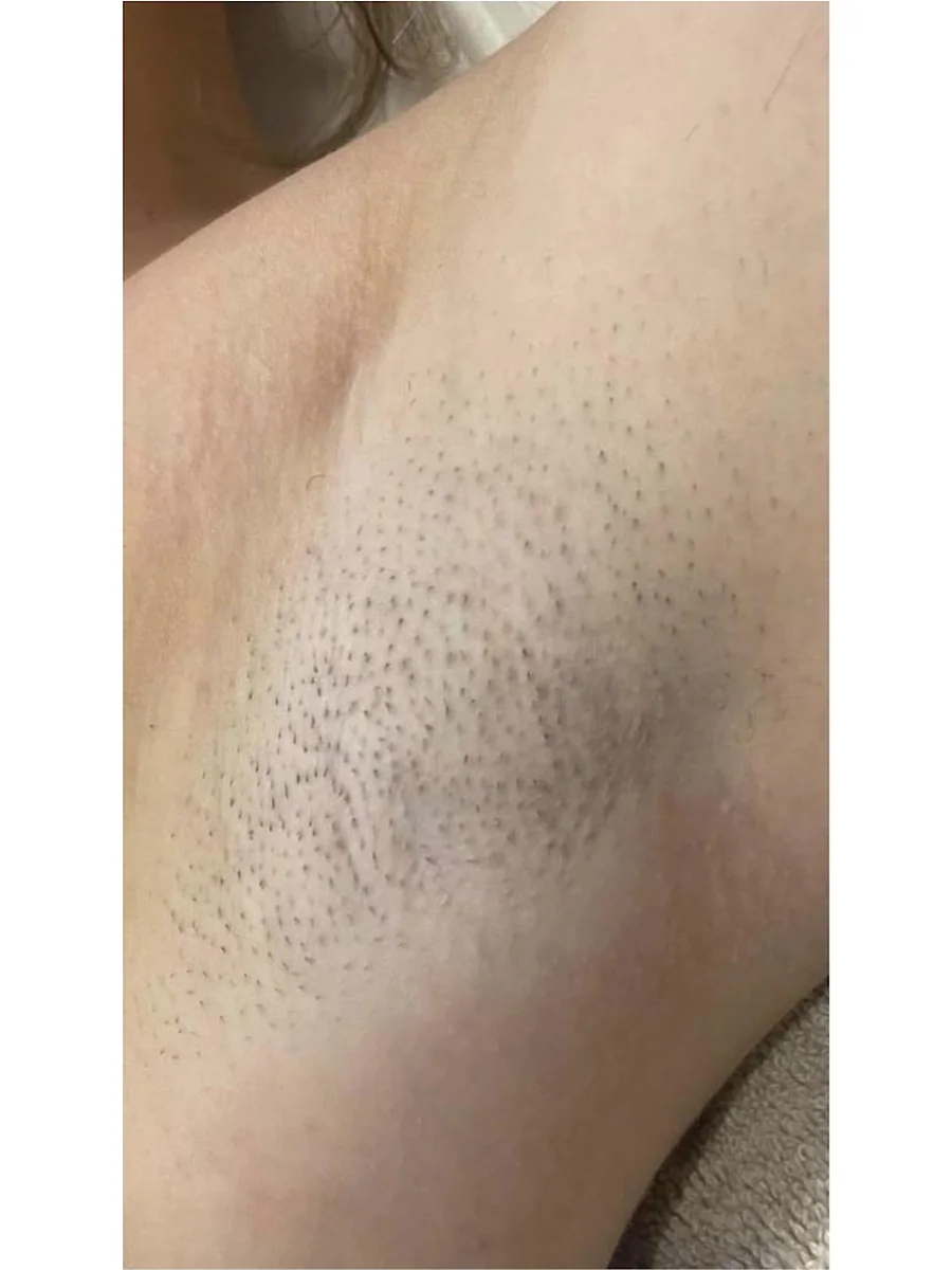 Laser Hair Removal before