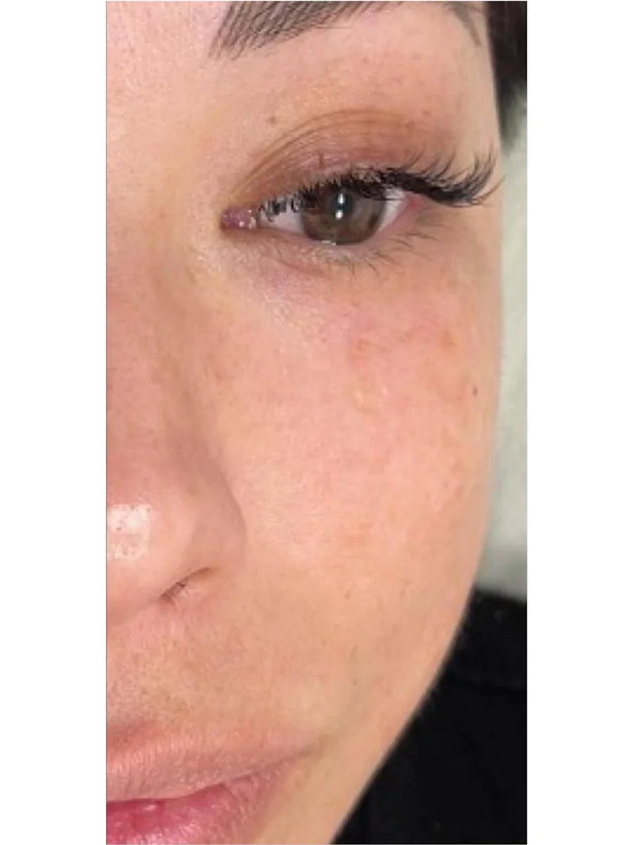 Skin Resurfacing after