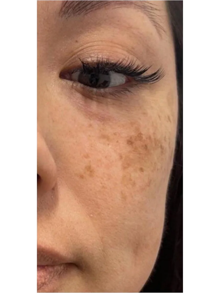 Skin Resurfacing before