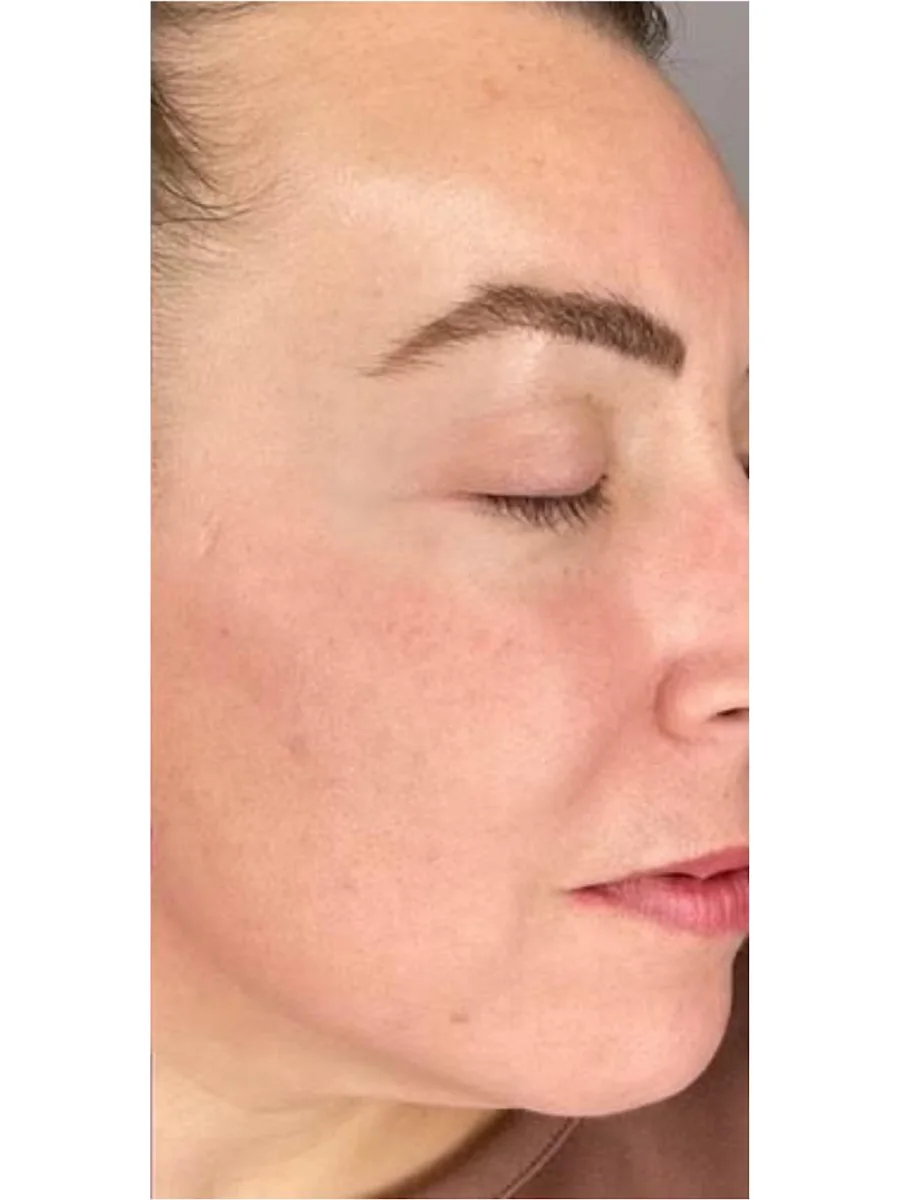 Skin Resurfacing after