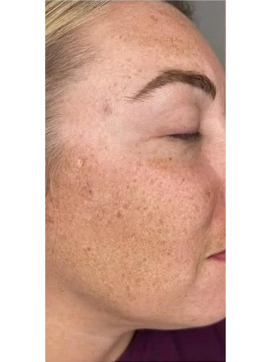 Skin Resurfacing before